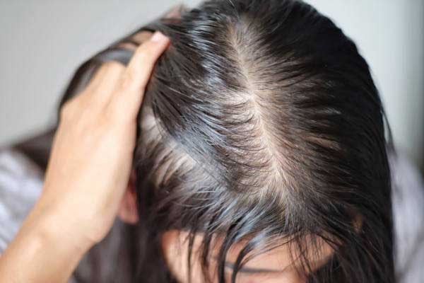 کاهش ریزش مو ناشی از چربی کف سر